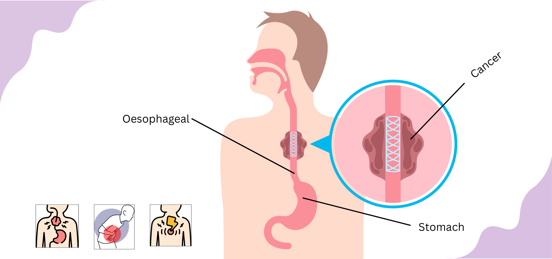 Esophageal Cancer
